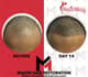 Slider image (10) MAXIM Hair Restoration Philippines